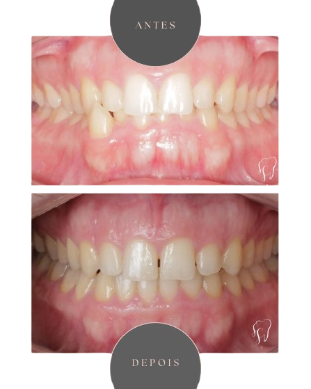 Antes e depois - Foto 02
